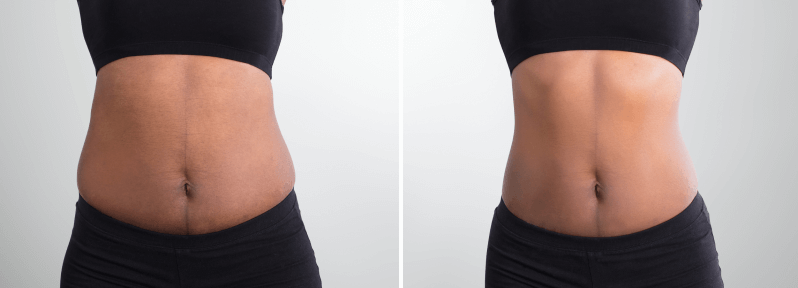 https://newstarmedspa.com/wp-content/uploads/2021/07/body-contouring-ba-1.png